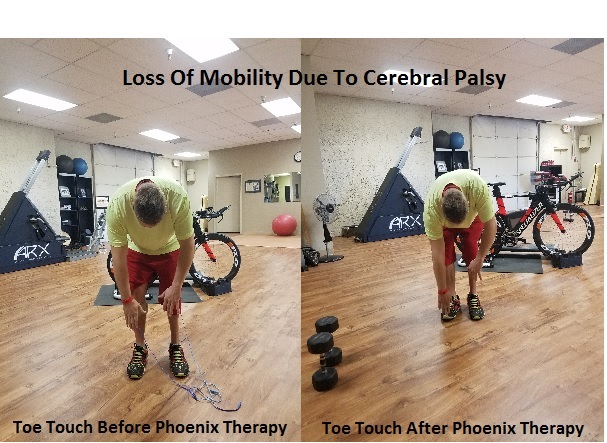 Before and after toe-touch improvment using Phoenix Waveform therapy showing neurological reactivation and increased mobility in a patient with cerebral palsy
